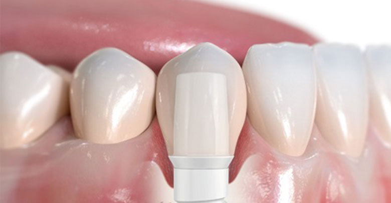 Holistic Tooth Replacement with Zirconia Dental Implants in Sacramento, CA