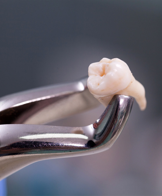 Wisdom Teeth Extraction: Everything You Need to Know