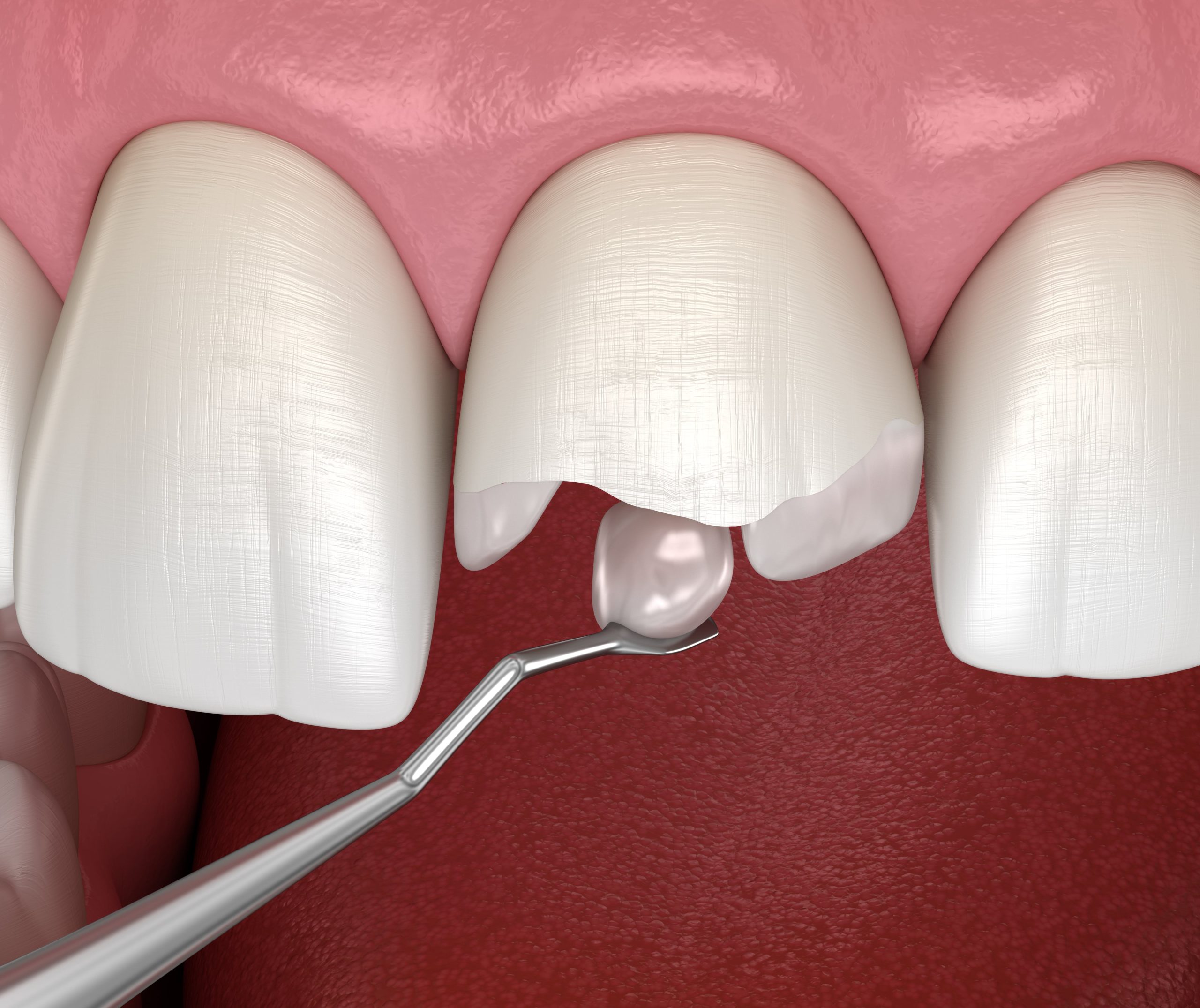 Is There BPA in Composite Fillings?