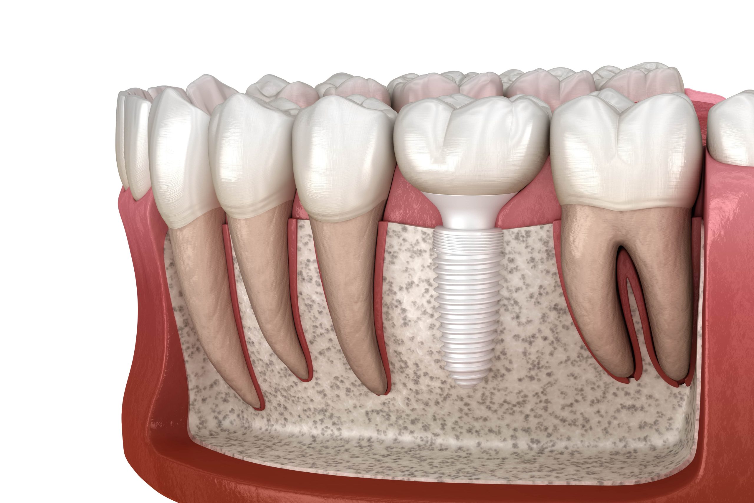 How Holistic Implants Are Shaping the Future of Dental Care