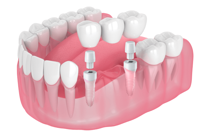 Why Sacramento Holistic Dentist says NO to "All on 4" and YES to Zirconia Dental Implants.