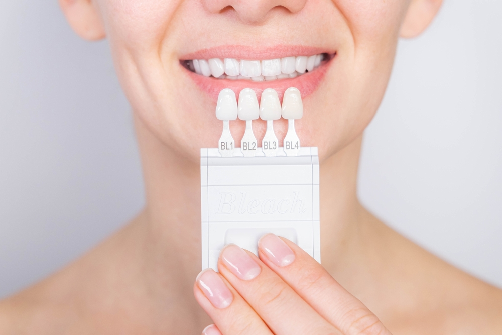 What Are Dental Veneers?