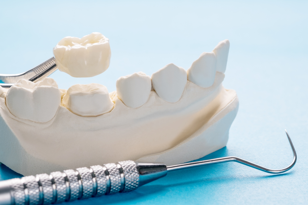 How Are Zirconia Implants Installed?