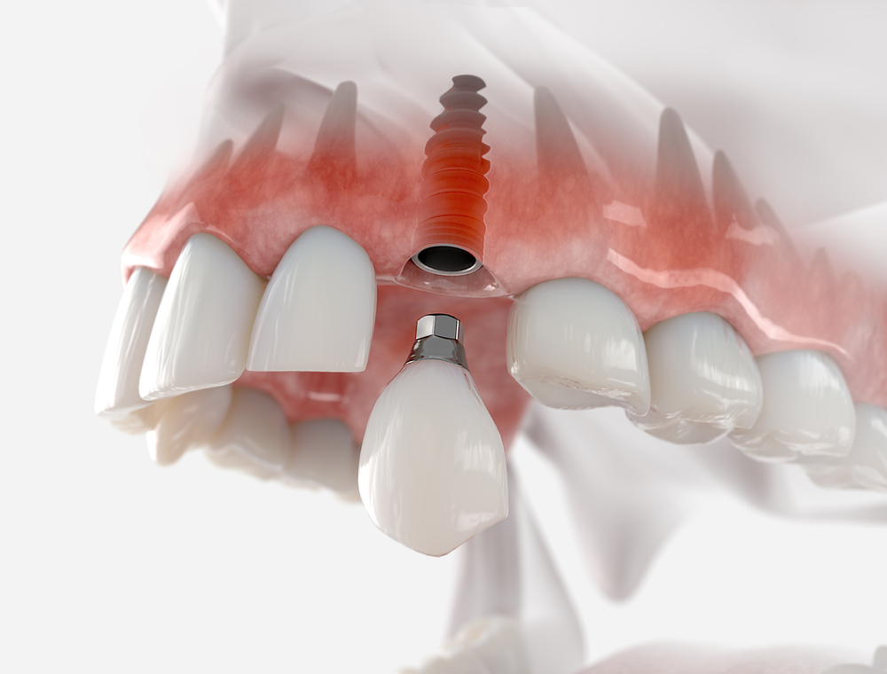 What are Zirconia Dental Implants?