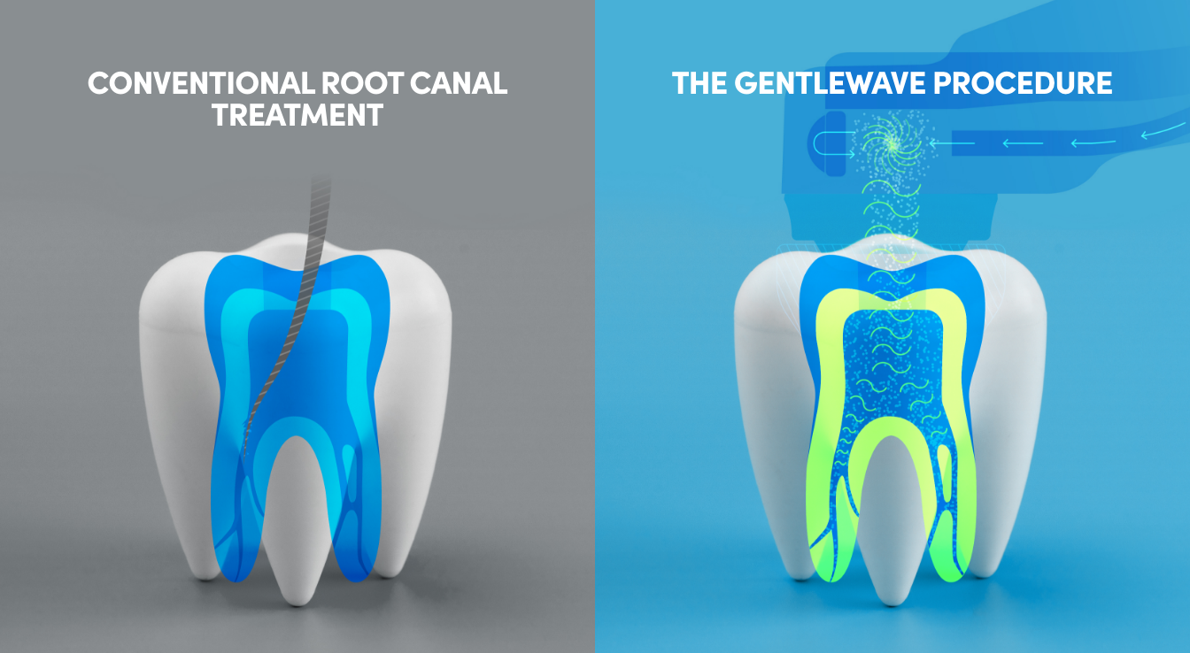 GentleWave offered at Sacramento Holistic Dentist is the better root canal option.