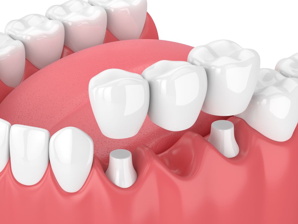 Implant Bridges vs. All-on-4s: What To Know