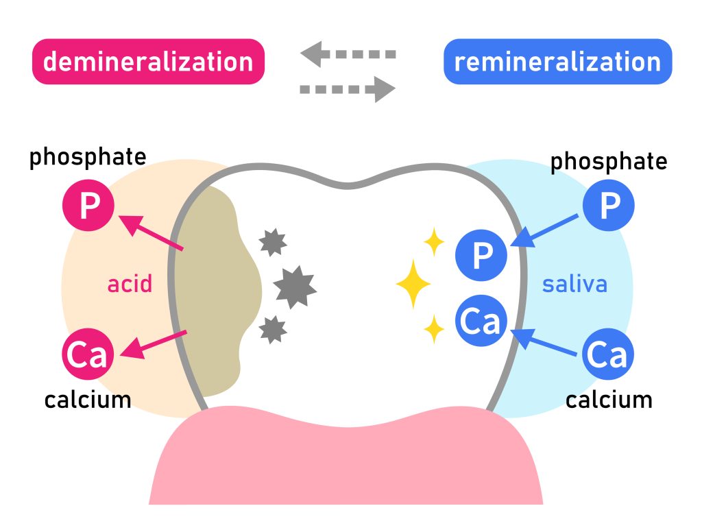 Diagram,Of,Tooth,Demineralization,And,Remineralization.,Dental,Care,Concept
