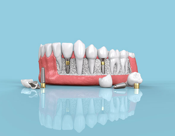 affordable implants2