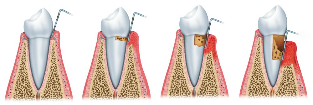 shutterstock periodontal disease progression