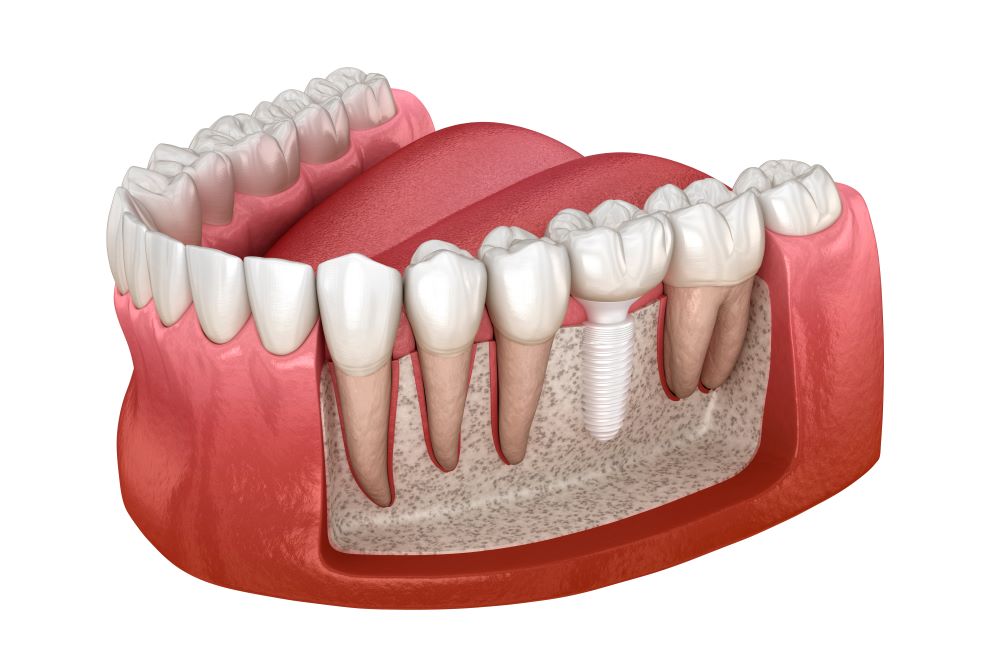 shutterstock ceramic dental implant 2
