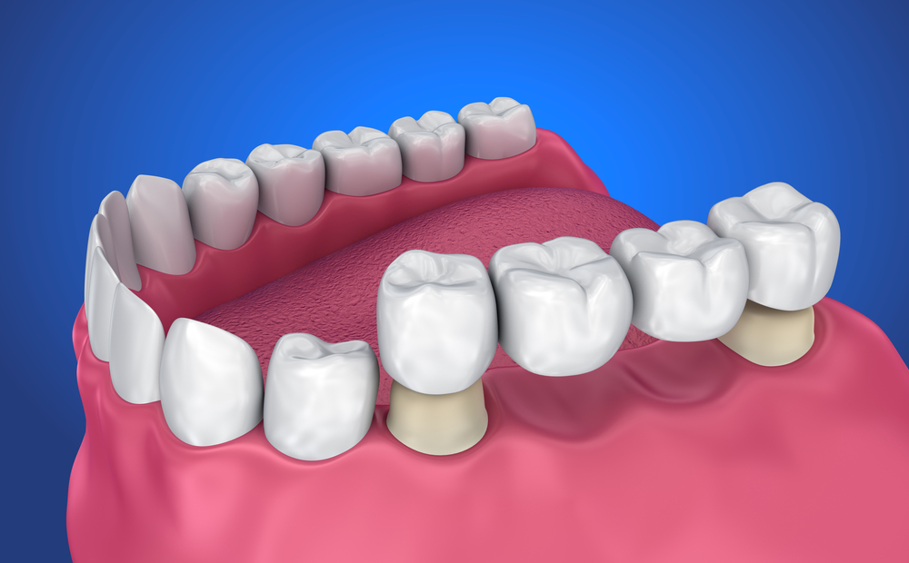 Tooth,Supported,Fixed,Bridge.,Medically,Accurate,3d,Illustration