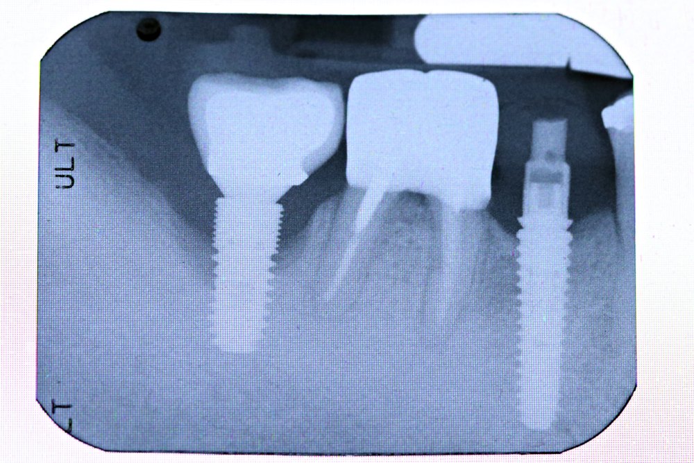 What causes bone loss around teeth? | Sacramento Holistic Dentist