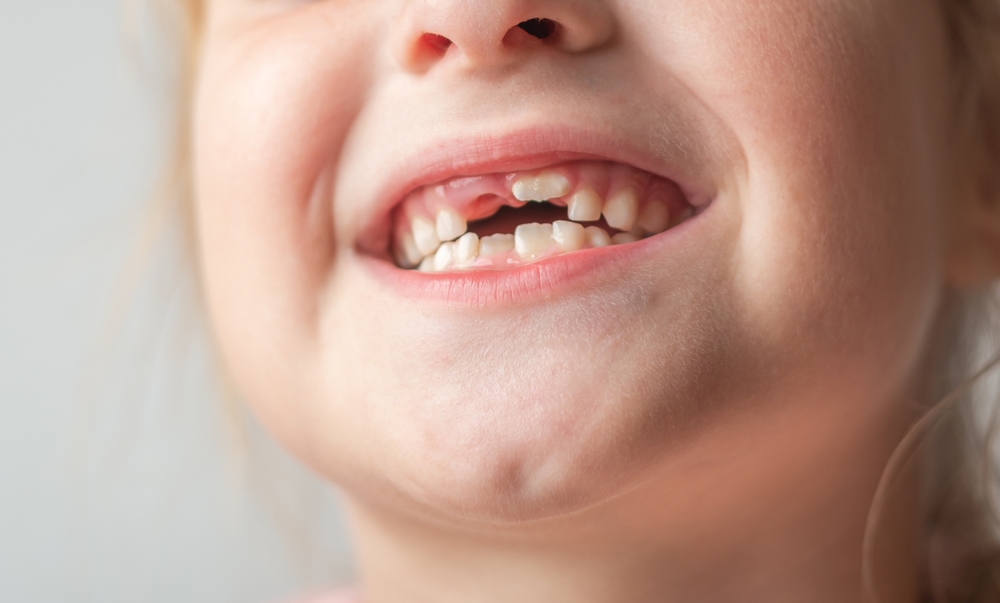 The,Child,Shows,Baby,Teeth.,Pediatric,Dentistry,And,Periodontology,,Bite