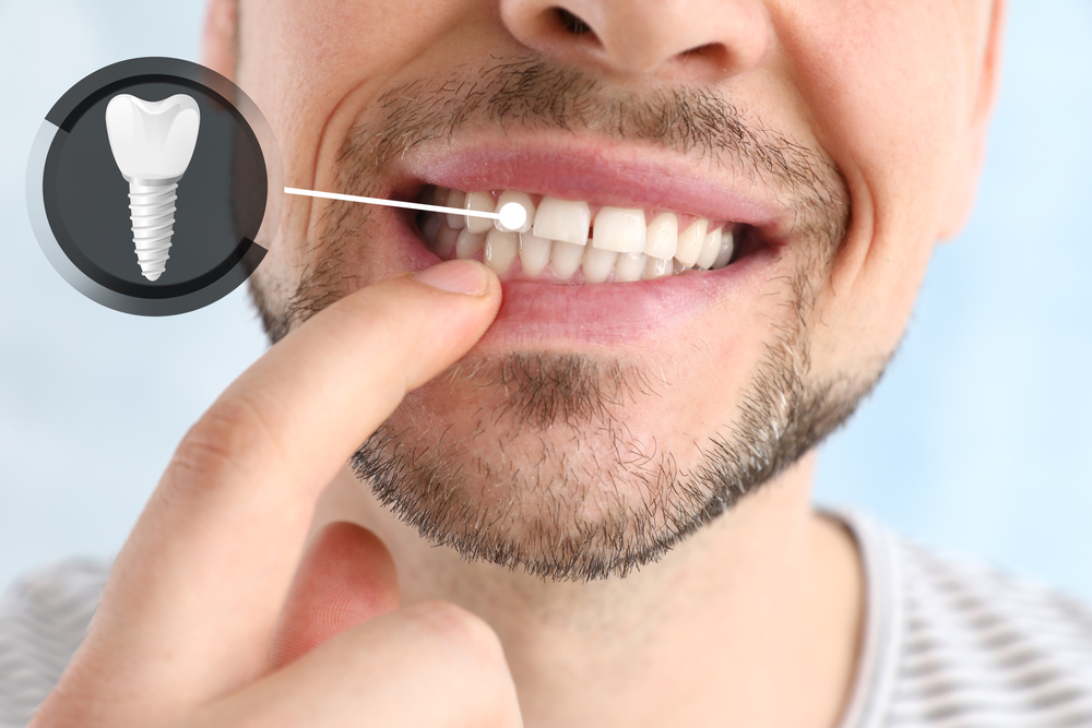 Man,Showing,Implanted,Teeth,On,Light,Background,,Closeup