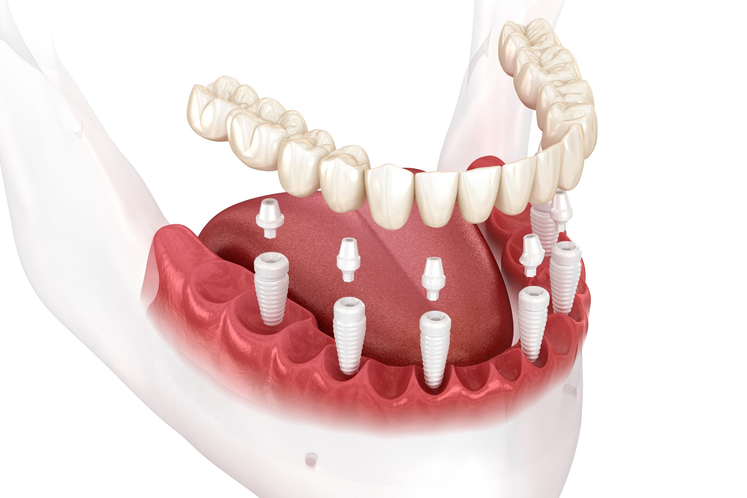 Removable,Mandibular,Prosthesis,All,On,6,System,Supported,By,Ceramic