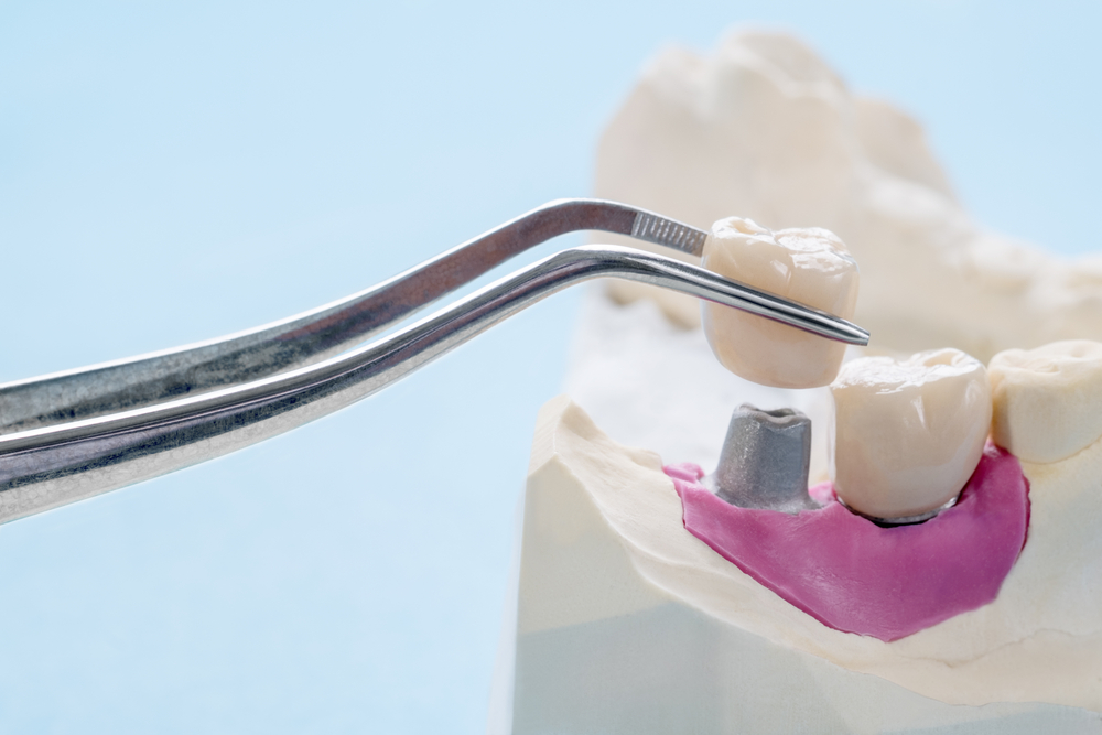 Closeup,/,Implant,Prosthodontics,Or,Prosthetic,/,Tooth,Crown,And